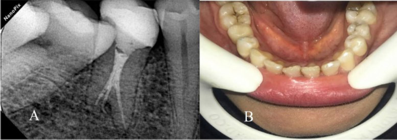 Endodontic Management of a Mandibular Second Premolar with Three Root Canals and Taurodontism: A Case Report.
