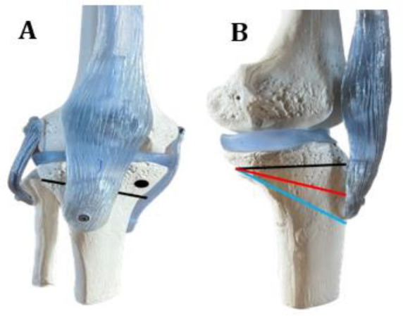 Simultaneous High Tibial Osteotomy and Anterior Cruciate Ligament Reconstruction in knees with Bony Frontal and/or Sagittal Deformities: Review of the Current Literature.