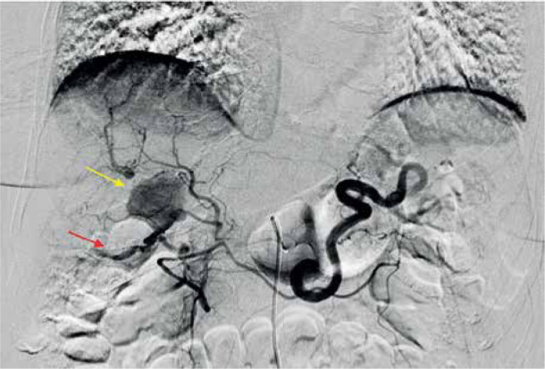 Intrahepatic aneurysm in a branch of the right hepatic artery in a patient with vasculitis due to systemic lupus erythematosus.