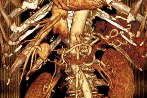 Intrahepatic aneurysm in a branch of the right hepatic artery in a patient with vasculitis due to systemic lupus erythematosus.