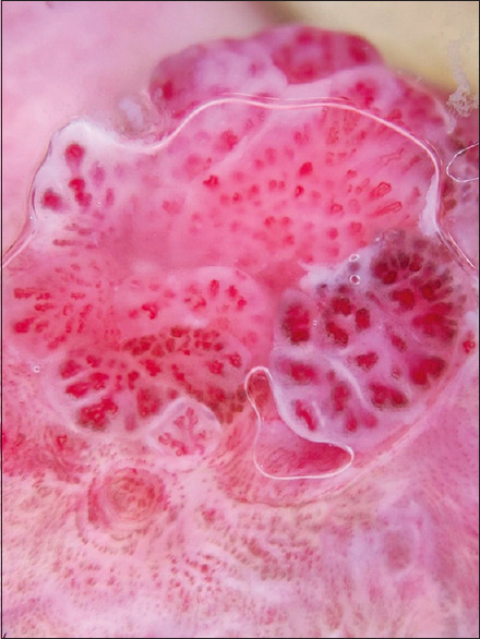 Intra-meatal urethral warts: Clinical and dermatoscopic perspectives.