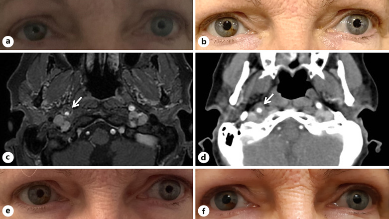 Internal Carotid Artery Dissection Presenting with Transient or Subclinical Horner Syndrome.