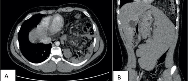 Left Portal Hypertension and Hypersplenism in a Child With Congenital Diaphragmatic Hernia: A Rare Case Report.