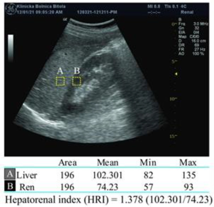 Prunus mume extract and choline treatment in patients with non-alcoholic fatty liver disease estimated by b-mode ultrasonography and hepatorenal index.