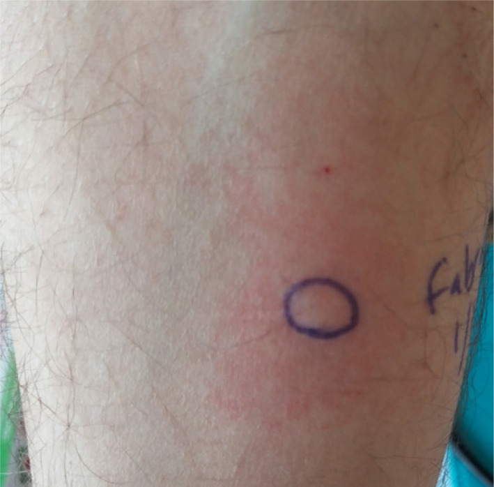 Successful treatment using agalsidase alfa of a patient with Fabry disease who had anaphylaxis after agalsidase beta: A case report.