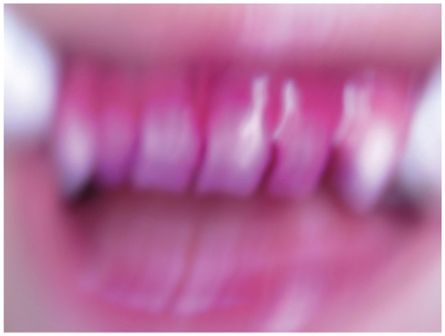 Among Artificial Intelligence/Machine Learning Methods, Automated Gradient-Boosting Models Accurately Score Intraoral Plaque in Non-Standardized Images.