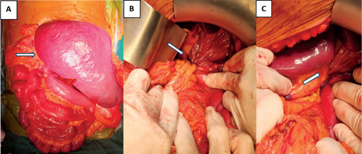 Left Portal Hypertension and Hypersplenism in a Child With Congenital Diaphragmatic Hernia: A Rare Case Report.