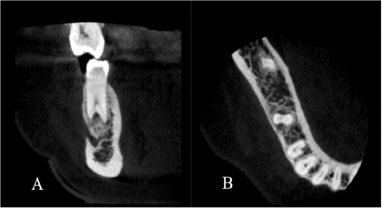 Endodontic Management of a Mandibular Second Premolar with Three Root Canals and Taurodontism: A Case Report.