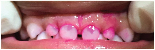 Among Artificial Intelligence/Machine Learning Methods, Automated Gradient-Boosting Models Accurately Score Intraoral Plaque in Non-Standardized Images.