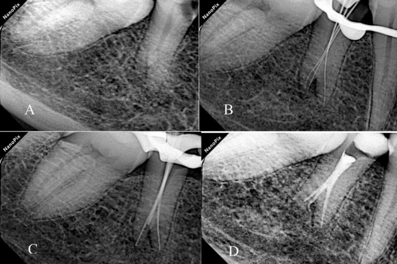 Endodontic Management of a Mandibular Second Premolar with Three Root Canals and Taurodontism: A Case Report.