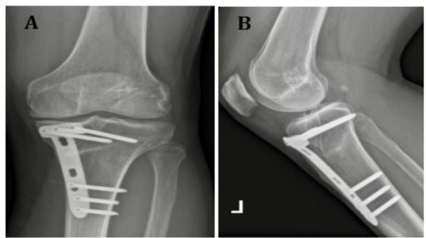 Simultaneous High Tibial Osteotomy and Anterior Cruciate Ligament Reconstruction in knees with Bony Frontal and/or Sagittal Deformities: Review of the Current Literature.