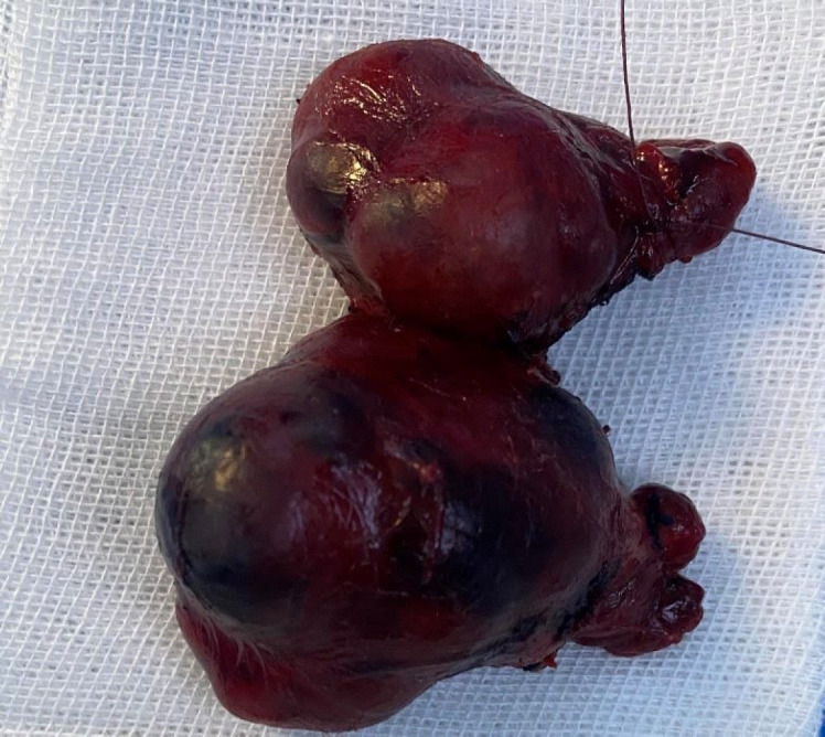Evaluation of Hematoma Formation after Thyroidectomy Surgery and Its Related Factors.