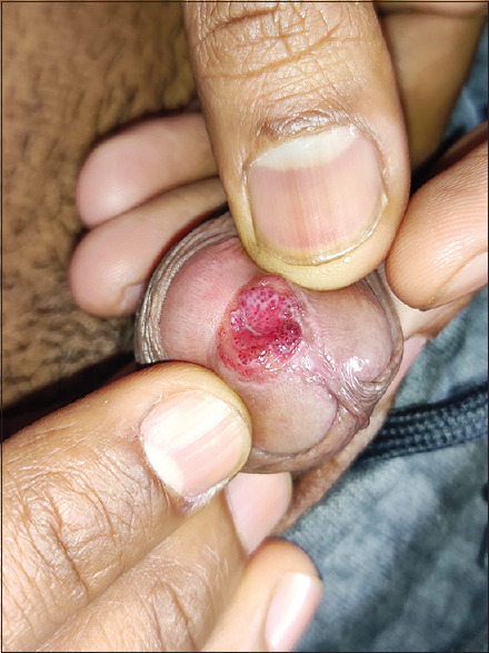 Intra-meatal urethral warts: Clinical and dermatoscopic perspectives.