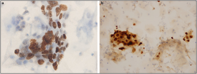 Comparison of ProExC and p16ink4a Biological Markers in Lesional Smears With the Immunocytochemical Method and Relationship With Human Papillomavirus in Liquid-based Cervicovaginal Specimens.