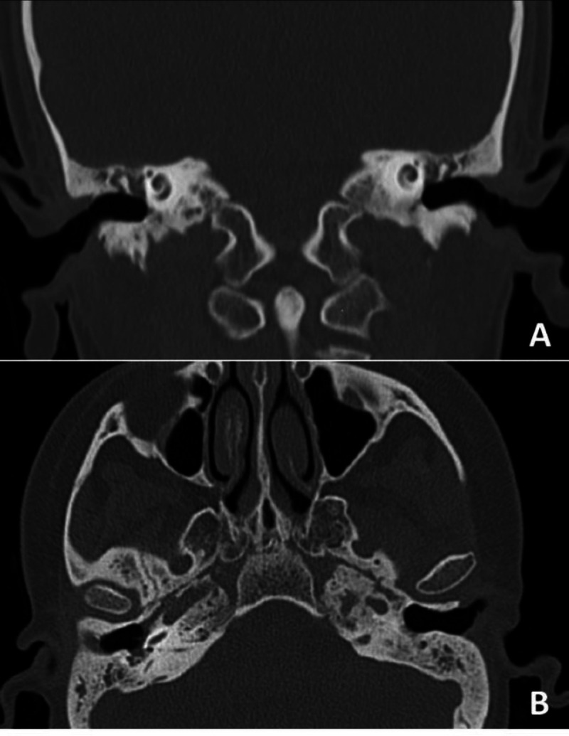 Cochlear Implantation with a Combined Approach: A Case Report.