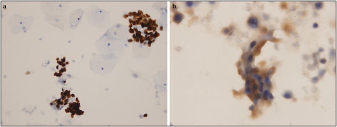 Comparison of ProExC and p16ink4a Biological Markers in Lesional Smears With the Immunocytochemical Method and Relationship With Human Papillomavirus in Liquid-based Cervicovaginal Specimens.