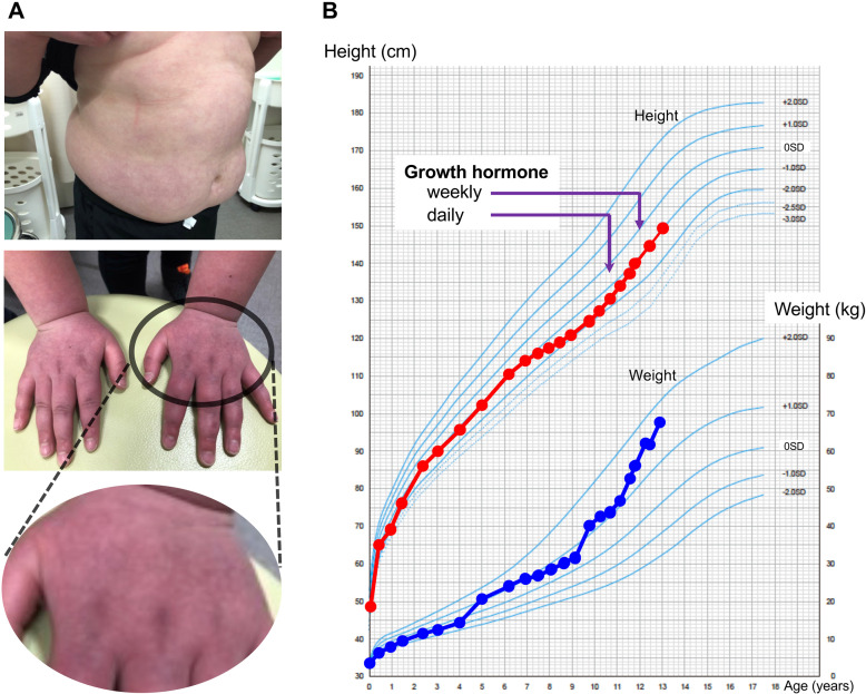 Adipsic hypernatremia with marked hyperprolactinemia and GH deficiency in a 9-year-old boy.