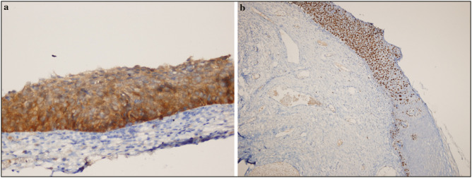 Comparison of ProExC and p16ink4a Biological Markers in Lesional Smears With the Immunocytochemical Method and Relationship With Human Papillomavirus in Liquid-based Cervicovaginal Specimens.