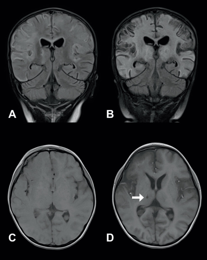 Clinical Features of Children With Anti-N-Methyl-D-Aspartate Receptor Encephalitis Following Viral Encephalitis.