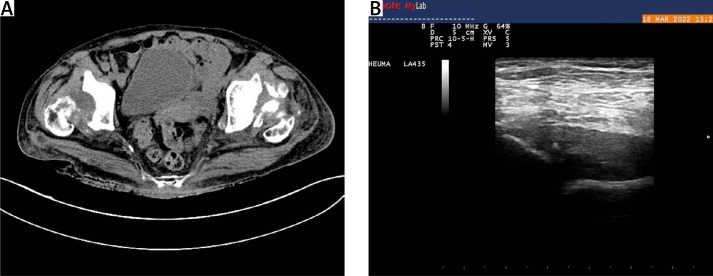 Bilateral rapidly destructive coxopathy in rheumatoid arthritis.