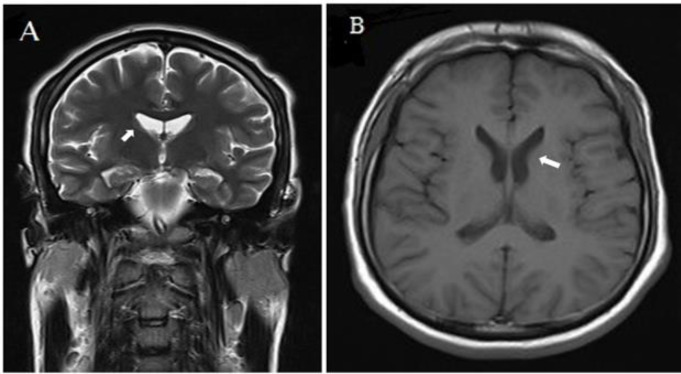 Long-term subclinical severe hyperCKemia associated with a rare VPS13A gene mutation in an Iranian patient: Case report.