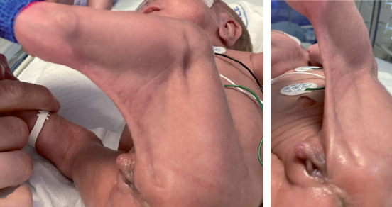 Transient clitoromegaly in an extremely preterm twin infant with popliteal pterygium.