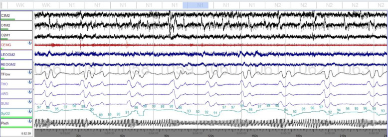 Severely obese 14-year-old boy with central sleep apnea several years after head trauma.