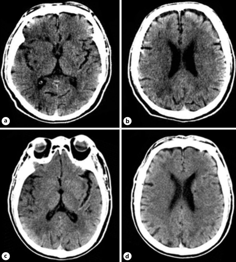 Near-Complete Reversal of Large Diffusion-Weighted Imaging Lesion after Thrombectomy: A Case Report and Literature Review.