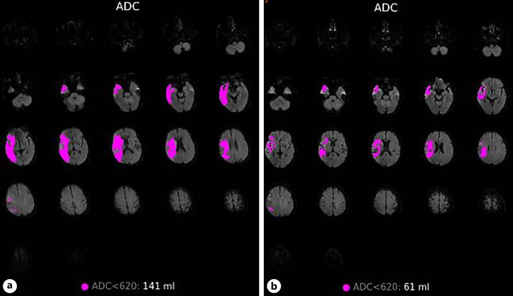 Near-Complete Reversal of Large Diffusion-Weighted Imaging Lesion after Thrombectomy: A Case Report and Literature Review.