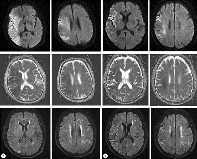 Near-Complete Reversal of Large Diffusion-Weighted Imaging Lesion after Thrombectomy: A Case Report and Literature Review.