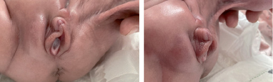 Transient clitoromegaly in an extremely preterm twin infant with popliteal pterygium.