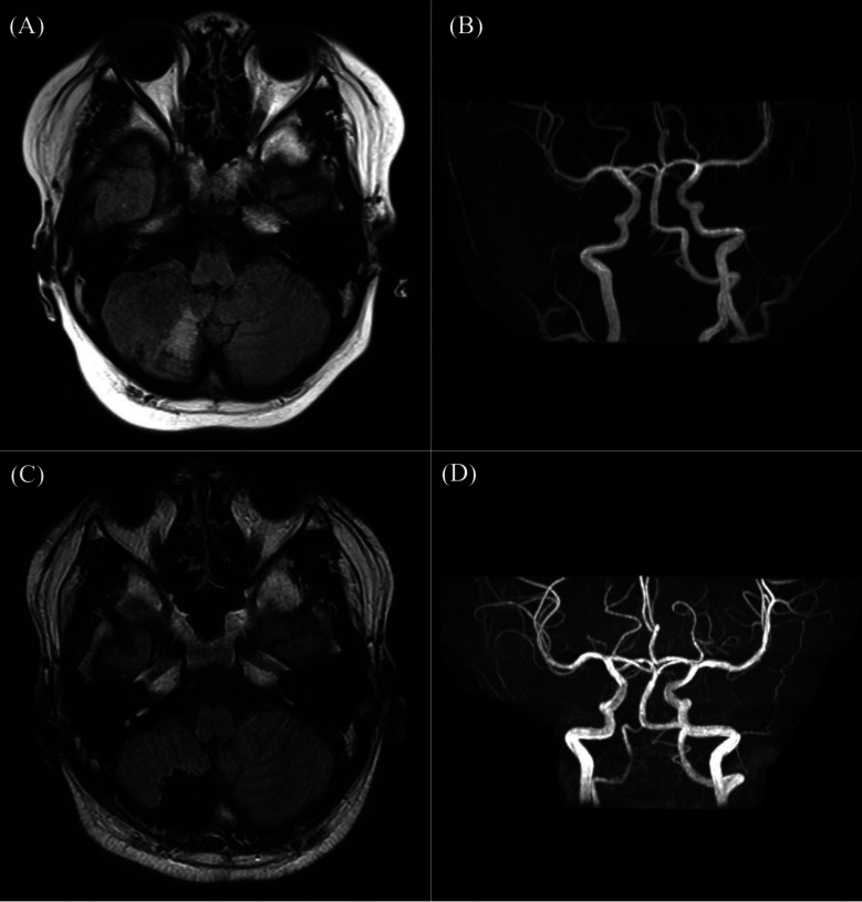 Severely obese 14-year-old boy with central sleep apnea several years after head trauma.