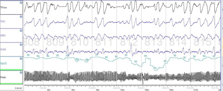 Severely obese 14-year-old boy with central sleep apnea several years after head trauma.
