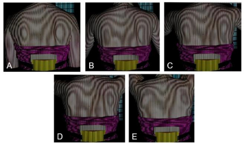 Quantitative Analysis of Scapular Winging Using Moire Topography.