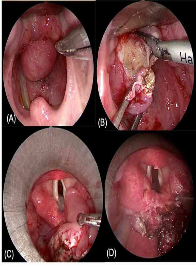 Transoral Endoscopic-Assisted Resection of Laryngeal Schwannoma: A Case Report.