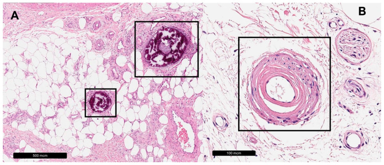 The Histopathology of Leg Ulcers.