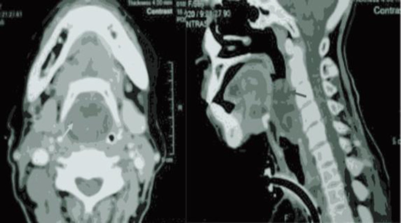 Transoral Endoscopic-Assisted Resection of Laryngeal Schwannoma: A Case Report.