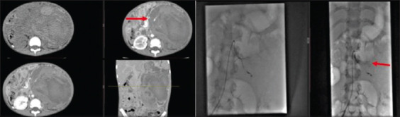 Emergency Angioembolization for Life-Threatening Hemorrhage in Wilms Tumor.