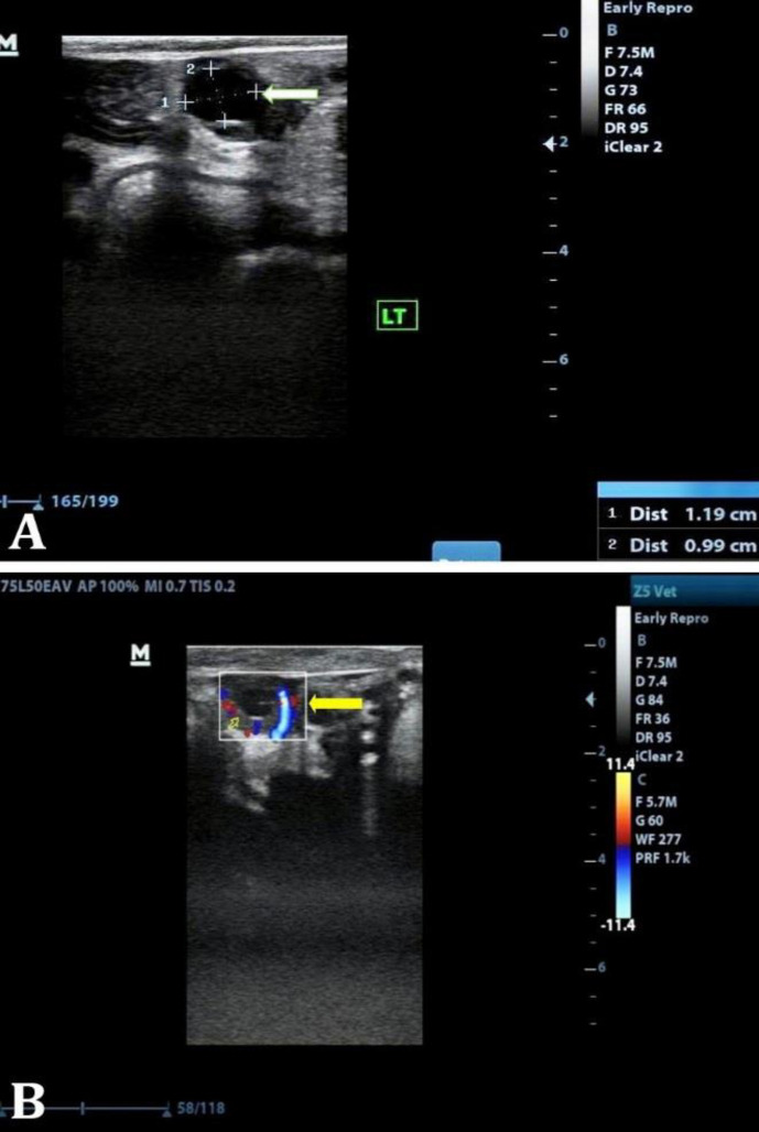 Temporal alteration in ovarian follicle fate with hormonal and hemodynamic perspectives during receptive phase of estrous cycle in endometritic cattle.