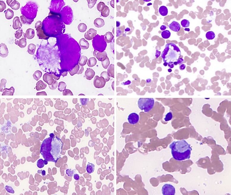 Myeloid Proliferations Associated with Down Syndrome: Clinicopathologic Characteristics of Forty Cases from Five Large Academic Institutions.