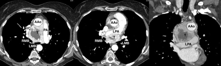 Effectiveness of cardiopulmonary bypass for radical resection of giant middle mediastinal paraganglioma.