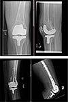 The linked nail/plate construct for the management of distal femur fractures in the elderly.