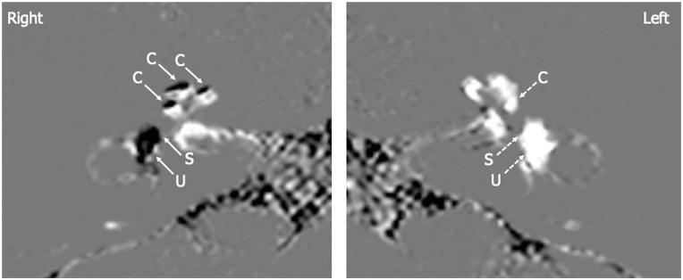 Potential Application of Hydrops MR Imaging: A Systematic Review.