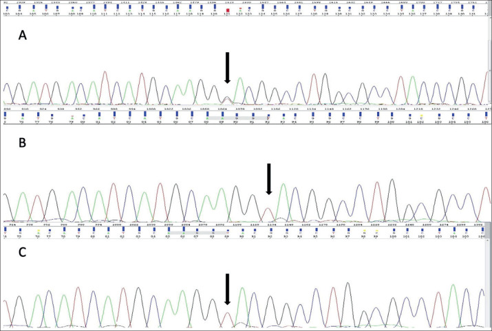 Novel Intronic Heterozygous Mutation in TSC2 Gene in Pediatric Patient with Tuberous Sclerosis Complex.