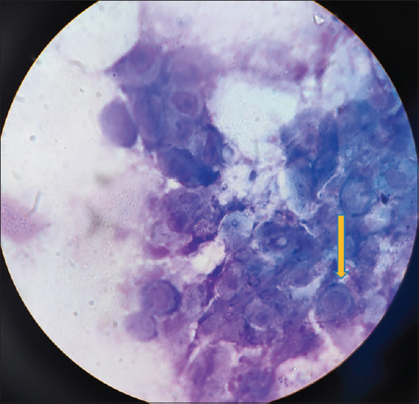 Pemphigus vulgaris in association with human immunodeficiency virus infection: A management dilemma.