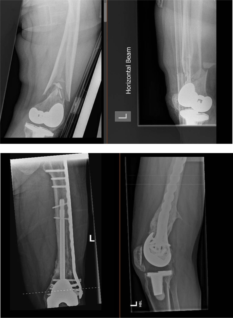 The linked nail/plate construct for the management of distal femur fractures in the elderly.