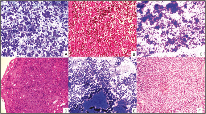 Evaluation of Fine-Needle Aspiration of Lymph Nodes and Assessment of Risk of Malignancy Based on the Sydney System of Reporting Lymph Node Cytology.