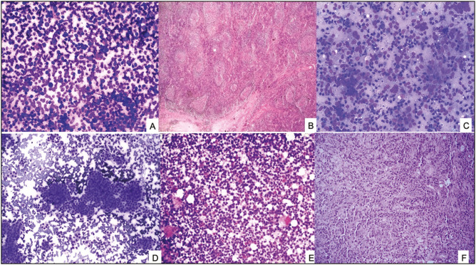 Evaluation of Fine-Needle Aspiration of Lymph Nodes and Assessment of Risk of Malignancy Based on the Sydney System of Reporting Lymph Node Cytology.