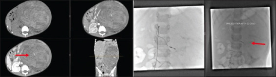 Emergency Angioembolization for Life-Threatening Hemorrhage in Wilms Tumor.