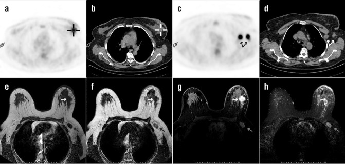 Comparison between <sup>18</sup>F-FDG PET/CT and diffusion-weighted imaging in detection of invasive ductal breast carcinoma.